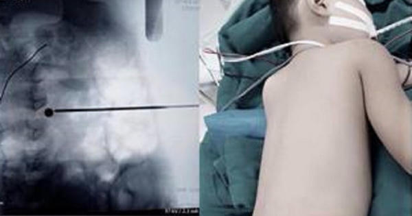 Nghịch súng tự chế, bé trai bị đạn bắn thủng lưng