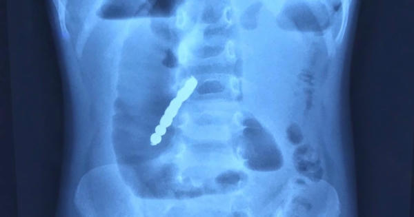 Bé gái 2 tuổi bị thủng ruột do nuốt phải bi nam châm đồ chơi