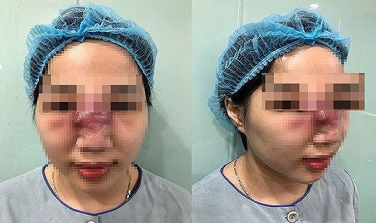 Nguy cơ hoại tử mũi vì tiêm filler tại spa