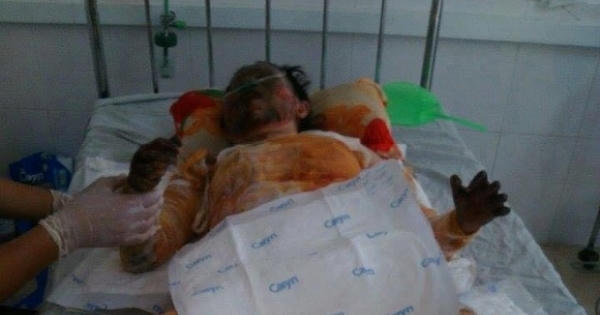 Xót thương cô gái xinh đẹp bị bỏng cấp độ 5 do xăng bất ngờ cháy