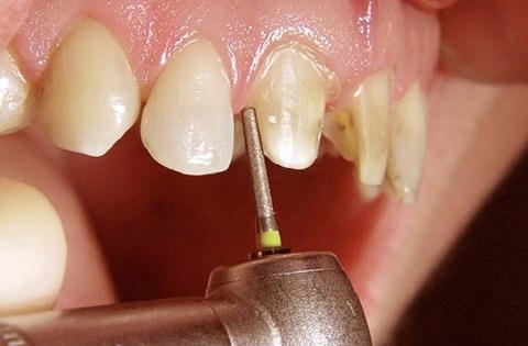 Mốt tàn sát răng thật lắp răng giả