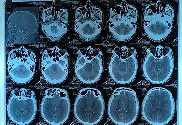 Tử vong vì uống cồn thay rượu