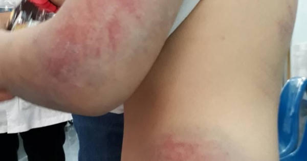 Vĩnh Phúc: “Ma men” dẫn lối, người cha tàn độc đánh con gái nhập viện Vĩnh Phúc: “Ma men” dẫn lối, người cha tàn độc đánh con gái nhập viện