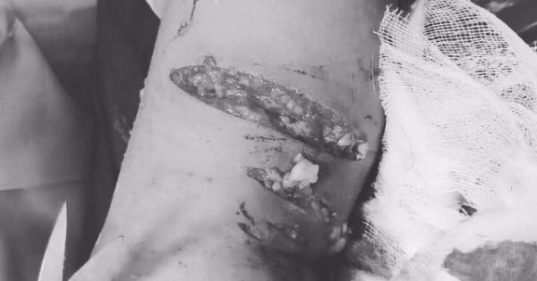 Bé trai 7 tuổi bị chó cắn với hơn 30 vết thương chằng chịt trên cơ thể Bé trai 7 tuổi bị chó cắn với hơn 30 vết thương chằng chịt trên cơ thể