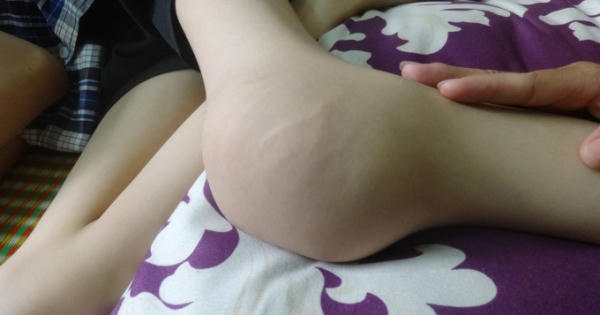 Khám, tư vấn miễn phí cho bệnh nhân biến dạng khớp gối do bệnh lý Hemophilia