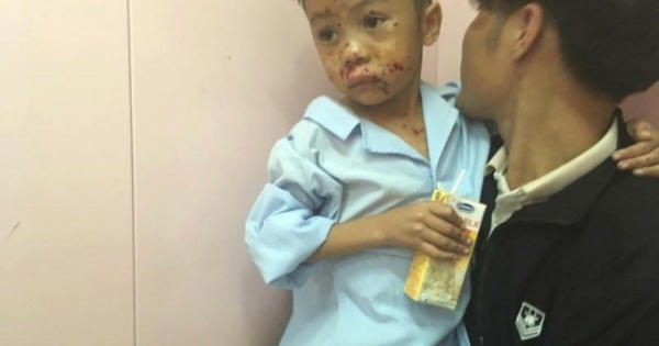 Hà Tĩnh: Hai anh em nhập viện cấp cứu vì nghi... đốt kíp mìn