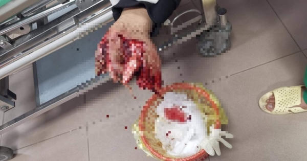 Pháo phát nổ khiến một thiếu niên nát bàn tay