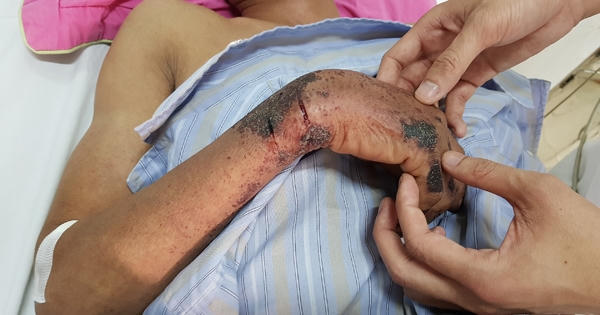 9 ca hoại tử vì liên cầu lợn do ăn tiết canh và tiếp xúc với lợn bệnh