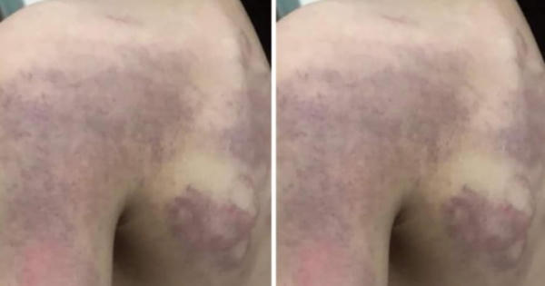 Xác minh thông tin học sinh lớp 3 bầm tím khắp lưng, bả vai khi đi học