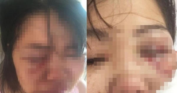 Hà Nội: Đòi ly hôn, người phụ nữ bị chồng đánh đập dã man như thời trung cổ