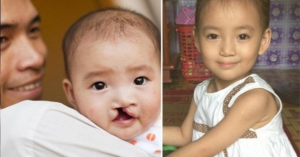 Cơ hội phẫu thuật miễn phí cho trẻ em hở hàm ếch