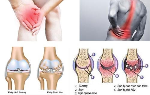 Bệnh viện Bạch Mai khám, tư vấn miễn phí bệnh cơ xương khớp