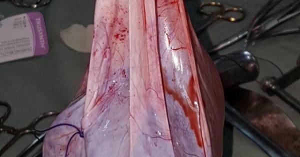 Nghệ An: Cắt bỏ thành công khối u nặng 6 kg ra khỏi ổ bụng của cụ bà 102 tuổi