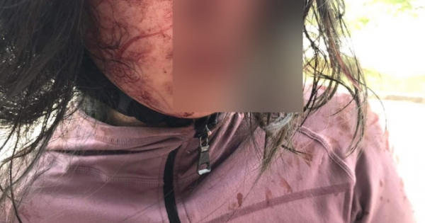 Đi làm thủ tục ly hôn, người vợ bất ngờ bị chồng rạch mặt