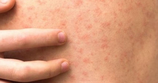 Bệnh sởi - mối đe dọa toàn cầu sắp xảy ra