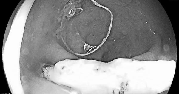 Quảng Bình: Nữ bệnh nhân bị vòng tránh thai đâm thủng trực tràng