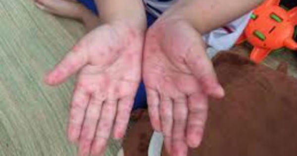 Lo ngại chủng vi rút Enterovirus 71 tái xuất gây tay - chân - miệng