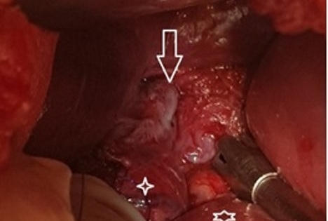 Sau tiệc nhậu, người đàn ông vỡ thực quản do nôn ói