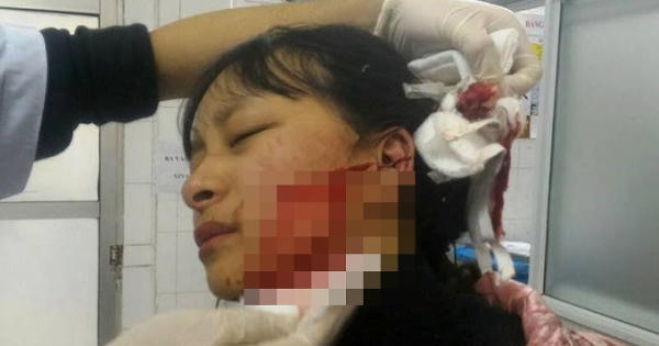 Khởi tố vụ án nữ sinh lớp 11 bị rạch mặt chỉ vì mâu thuẫn cá nhân