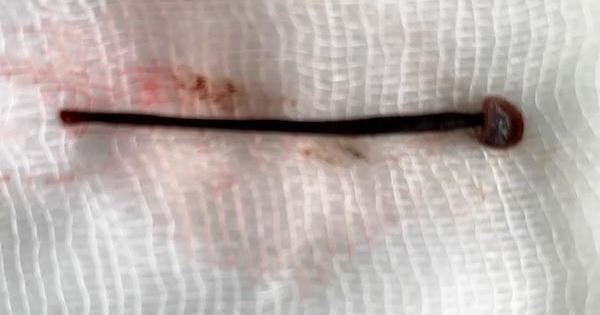 Nữ sinh viên rửa mặt ở suối bị đỉa chui vào mũi
