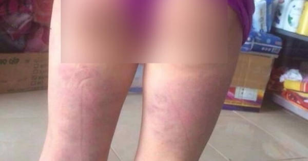 Nghệ An: Khiển trách cô giáo dùng thước đánh học sinh bầm tím người