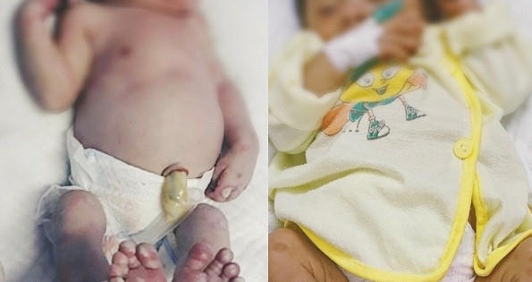 Bé gái sơ sinh chân tay lở loét, vì mắc phải bệnh giang mai bẩm sinh Bé gái sơ sinh chân tay lở loét, vì mắc phải bệnh giang mai bẩm sinh