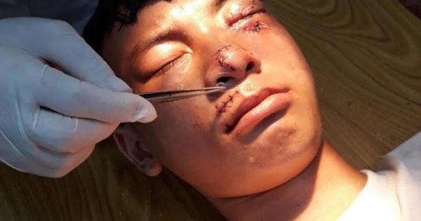 Nam định: Nam sinh lớp 10 bị nát mặt vì chó lạ tấn công Nam định: Nam sinh lớp 10 bị nát mặt vì chó lạ tấn công