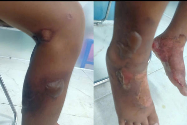 Giám định thương tật đối với bé trai bị bỏng rộp nghi do cha đẻ bạo hành ở TP HCM