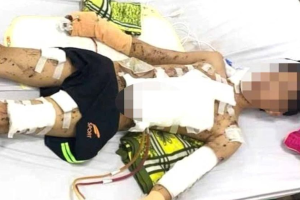 Một học sinh ở Quảng Bình bị thương tích nặng do pháo tự chế