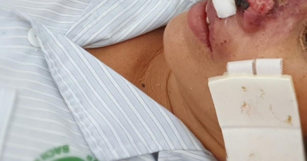 Vi khuẩn Whitmore “ăn thịt người" có ở khắp nơi, nhiều người mắc bệnh