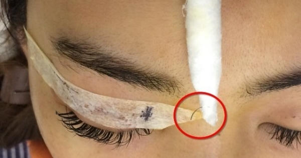 Thiếu nữ ở Hà Nội đi nhấn mí bị nhấn... cả kim khâu vào mắt