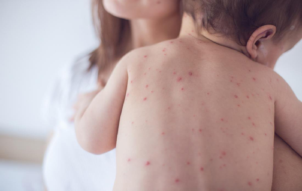 Bé 2 tuổi ở Cao Bằng tử vong nghi do mắc sởi