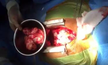 Phẫu thuật bóc thành công khối u 700gr trong lồng ngực gây chèn ép tim