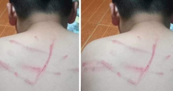 Thanh Hóa: Tạm đình chỉ cô giáo đánh bầm tím lưng học sinh