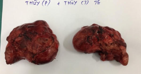Choáng với hình ảnh hai khối u “siêu khổng lồ” được lấy ra từ cổ cụ bà 79 tuổi