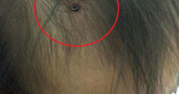 Bé gái 19 tháng bị đóng đinh vít vào đầu