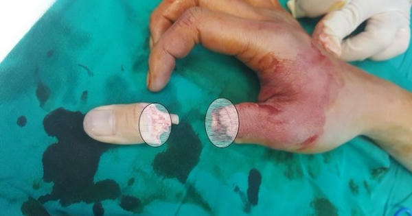 Dây cáp điện thoại rơi xuống cắt lìa ngón tay người đi đường Dây cáp điện thoại rơi xuống cắt lìa ngón tay người đi đường