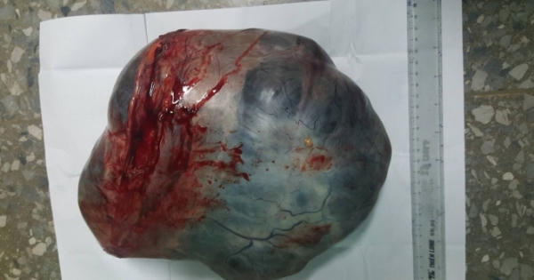 Quảng Bình: Mổ khối u khủng nặng hơn 4kg trong bụng cụ bà