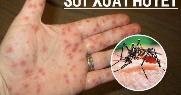 Có phải cứ có biểu hiện "xuất huyết" thì mới bị bệnh sốt xuất huyết? Có phải cứ có biểu hiện "xuất huyết" thì mới bị bệnh sốt xuất huyết?