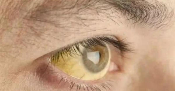 4 dấu hiệu trên khuôn mặt cảnh báo gan đang kêu cứu