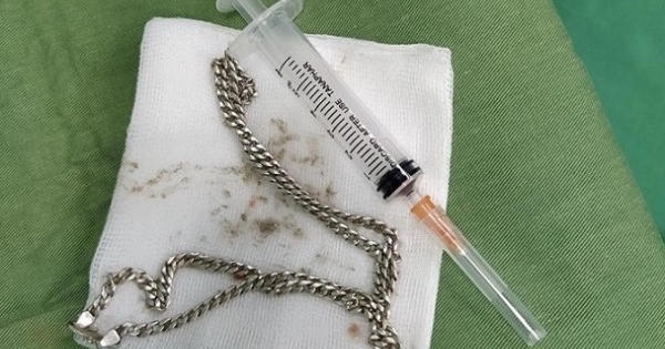 Chơi đùa một mình, bé 29 tháng tuổi nuốt cả sợi dây chuyền bạc vào sâu trong tá tràng