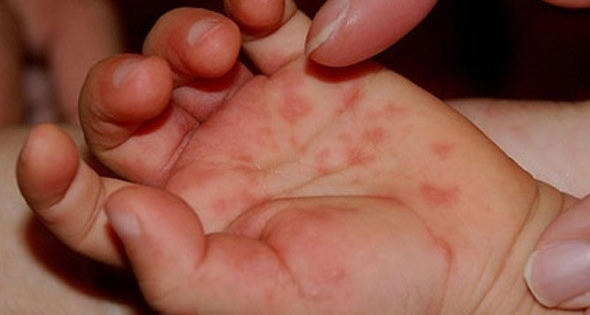Lo ngại bùng phát dịch tay chân miệng, Bộ Y tế khuyến cáo phòng dịch Lo ngại bùng phát dịch tay chân miệng, Bộ Y tế khuyến cáo phòng dịch