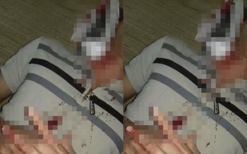 Hòa Bình: Đang điều tra vụ nghi vấn đạn lạc trúng cổ nam thanh niên