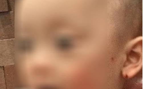 Bé trai 20 tháng bị cắn tím lưng: Hai vợ chồng hiệu trưởng trường mầm non đến tận nhà xin lỗi