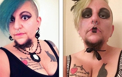 Mắc hội chứng buồng trứng đa nang, người phụ nữ mọc râu rậm như đàn ông