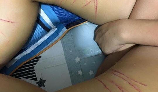 Xôn xao thông tin thiếu nữ bị kẻ biến thái dùng dao tem rạch đùi ở Hà Nội