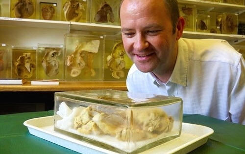 Bệnh nhân được nhìn tận mắt quả tim của mình sau 7 năm