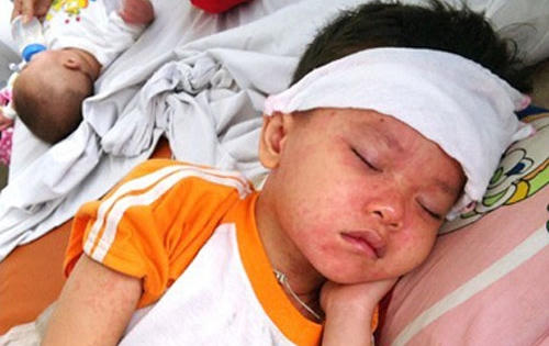 Hà Nội: Một trường hợp tử vong do sởi