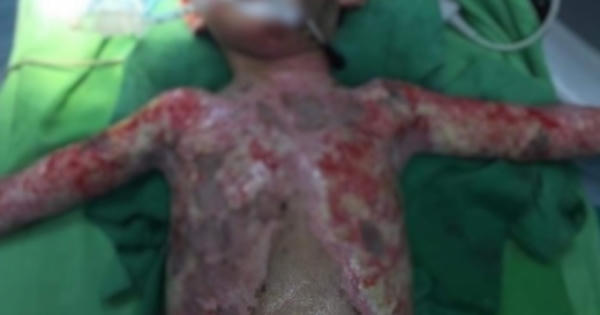 Xót xa, bé trai 5 tuổi bỏng đến 40 % cơ thể do nghịch chiếc bật lửa