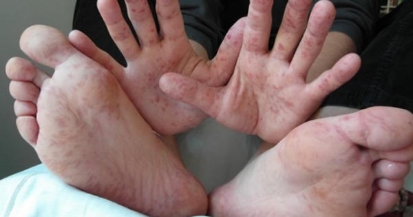 Cẩn trọng dịch tay chân miệng bùng phát